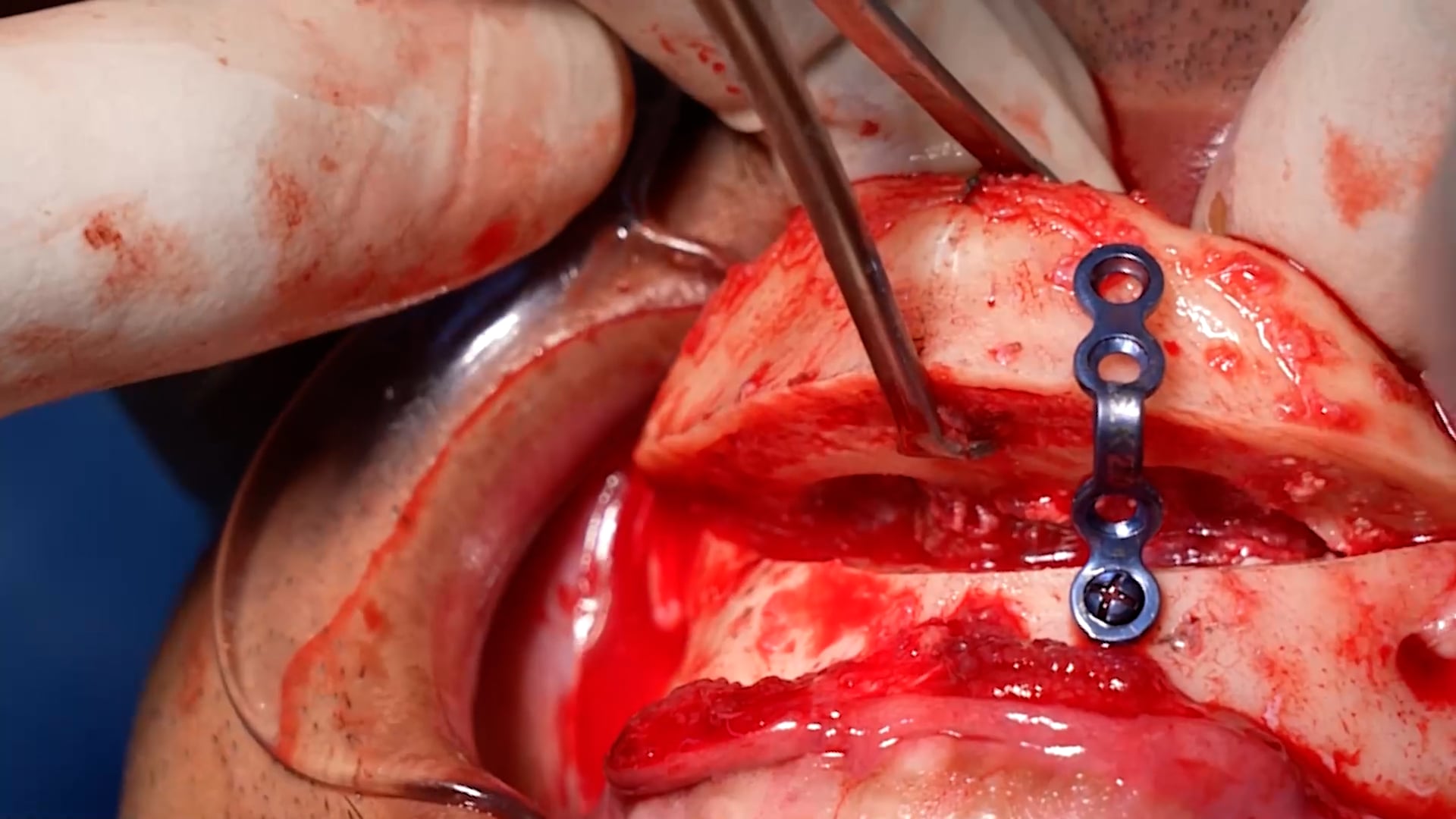 Chin Augmentation Surgery